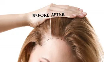 Tratament împotriva căderii părului pentru femei